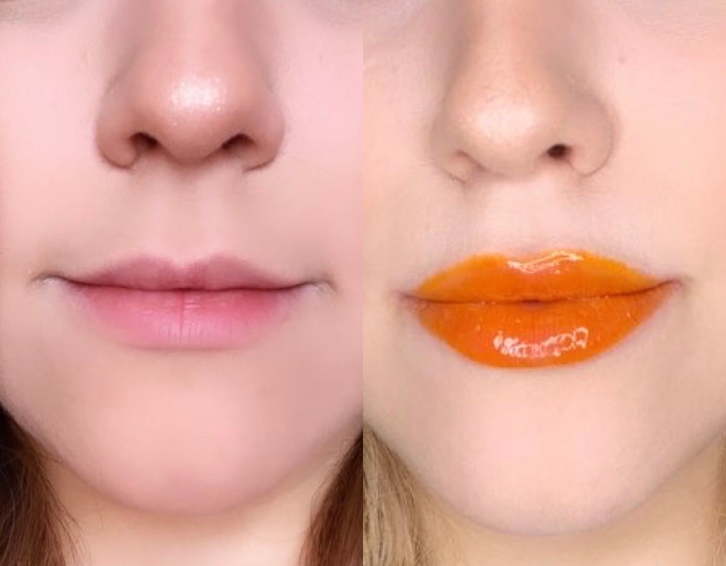 Voluminizador de Labios Grado 2 - Ultra Lip Plumper