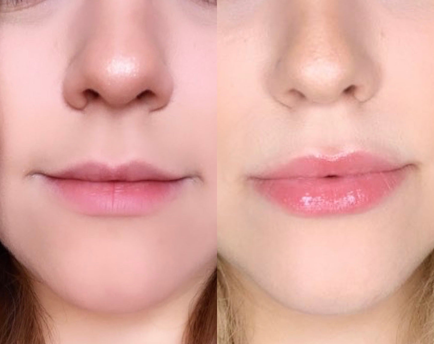 Voluminizador de Labios Grado 1 - Lip Plumper