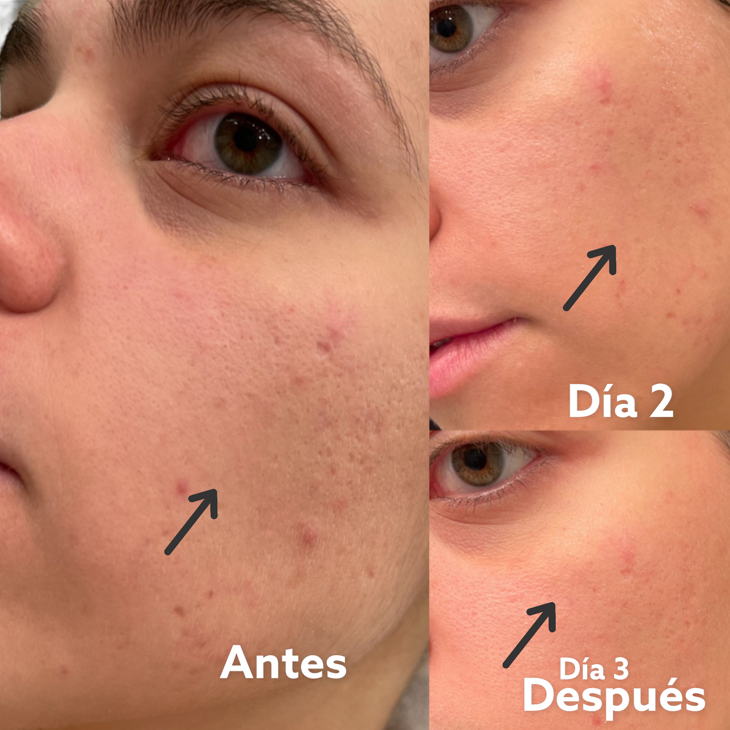 Kit Antiacné - Antiacne Kit SOP
