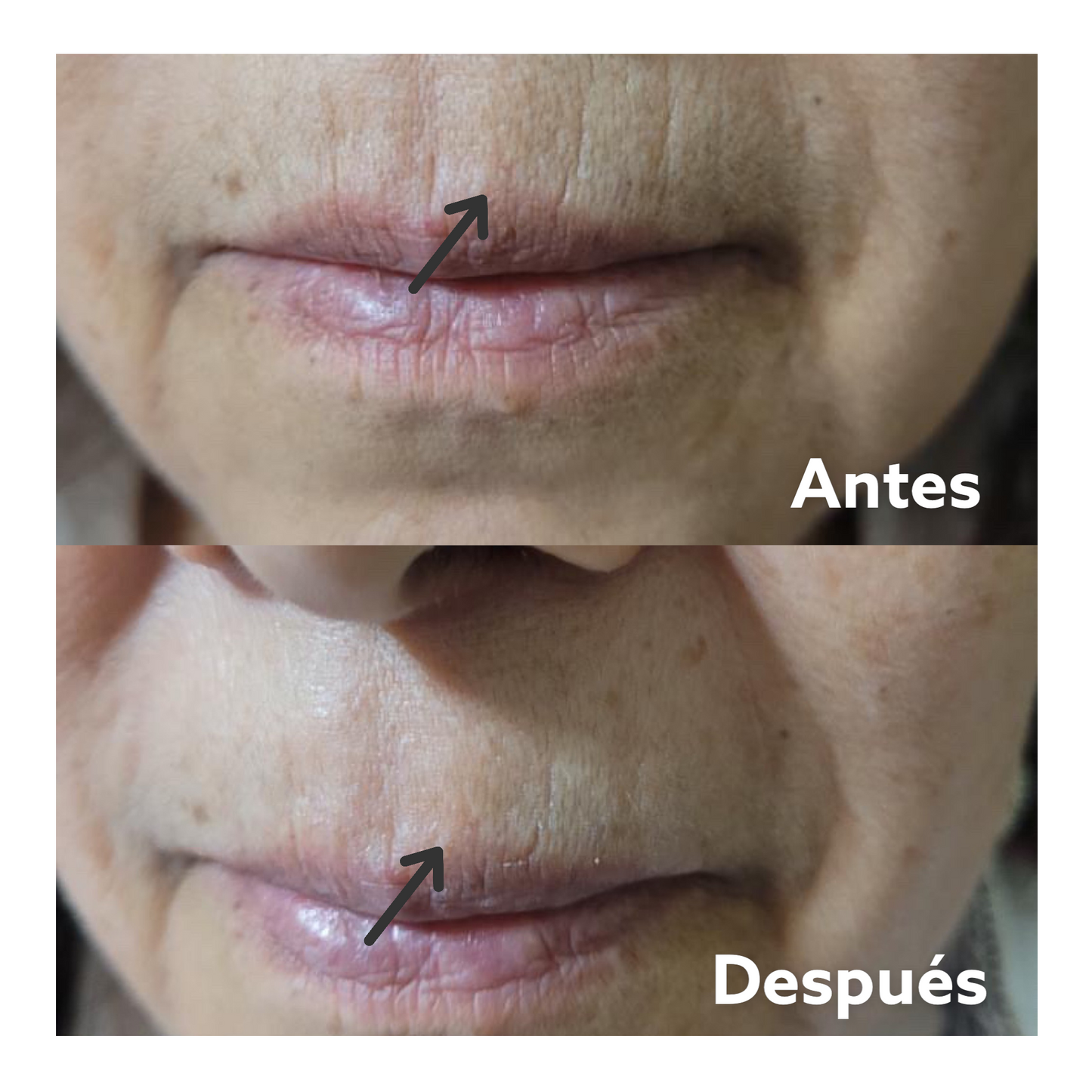 Antiarrugas Instantáneo - Face Plumper